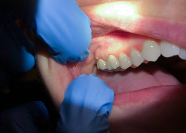 Best Emergency Gum Pain Relief  in Pierre Part, LA