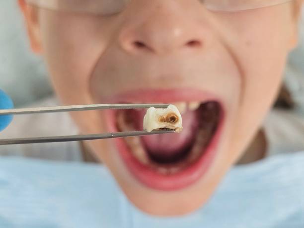 Best Cracked Tooth Emergency Dentist  in Pierre Part, LA